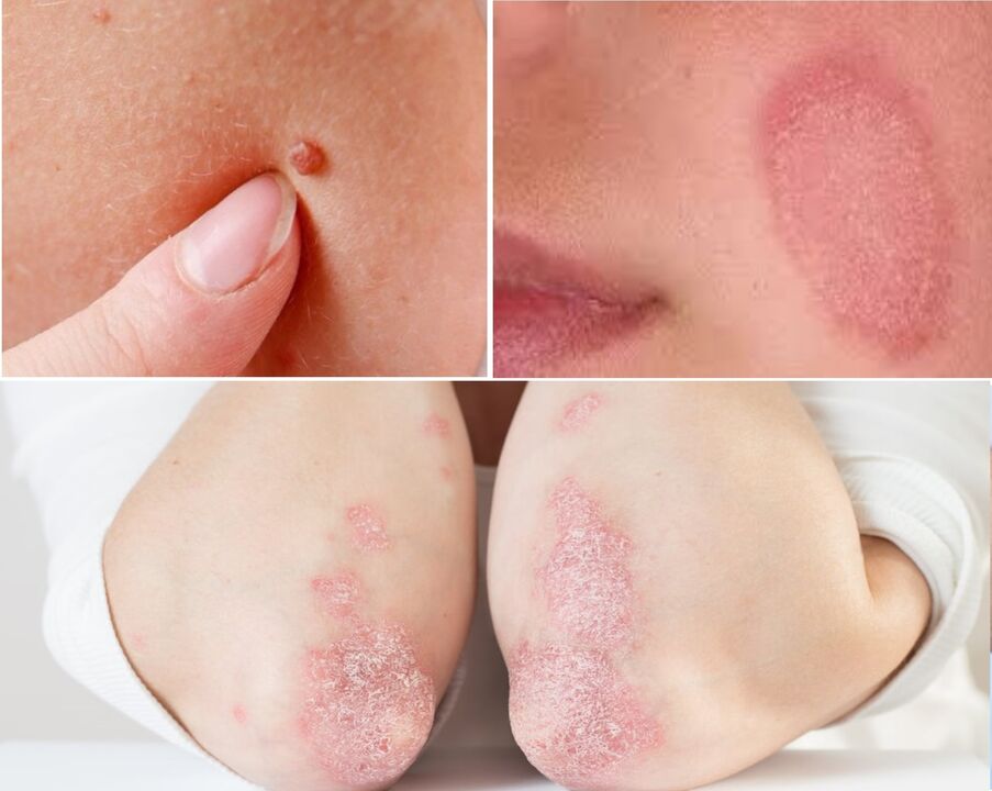 La queramina es eficaz contra papilomas, hongos y psoriasis.