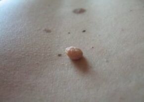 El papiloma es un crecimiento en la superficie de la piel.