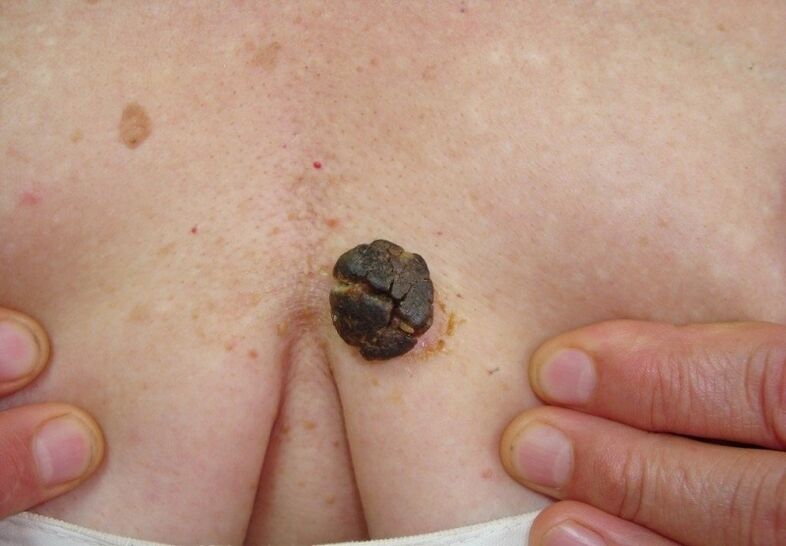 queratoma en el cuerpo humano