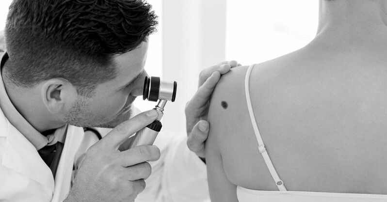 un especialista diagnostica el tipo de verruga