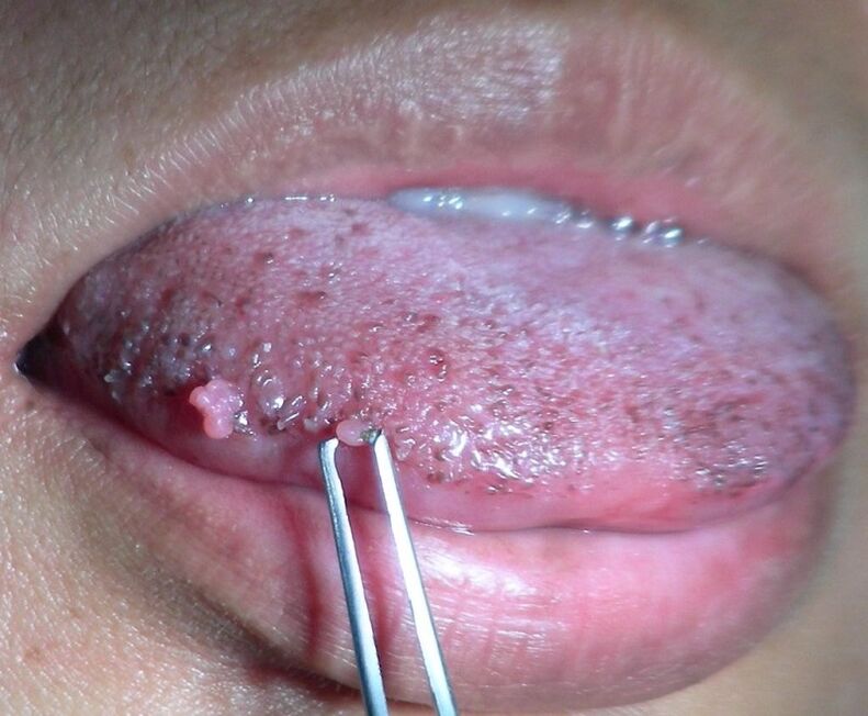 verrugas en la lengua