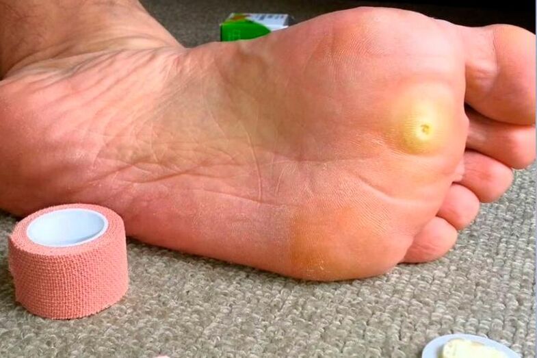 verruga plantar en el pie