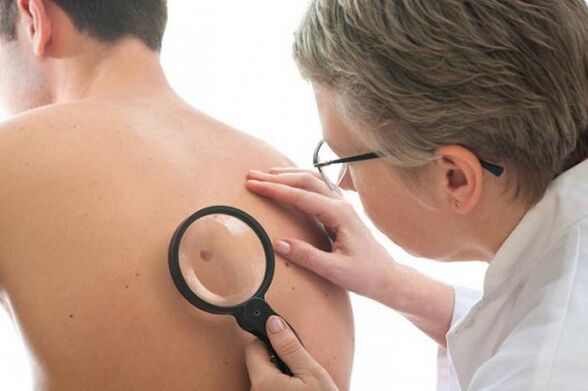 el médico examina el papiloma en la espalda