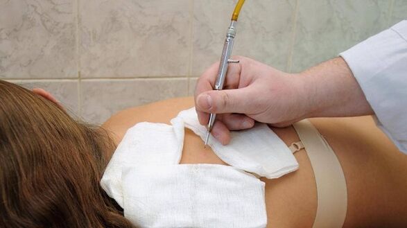 electrocoagulación del papiloma en la espalda.