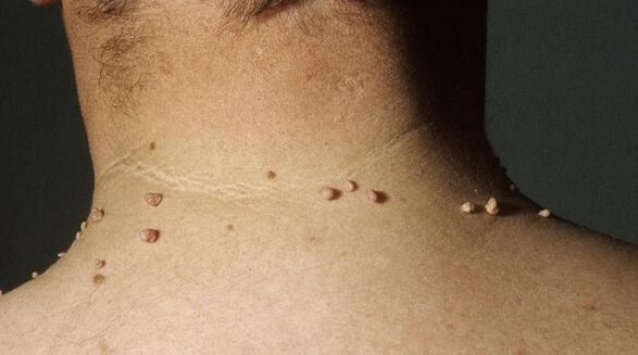 papiloma filiforme en el cuello