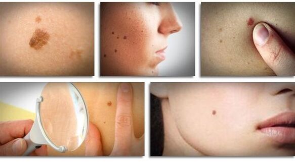 tipos de papilomas virales en el cuerpo
